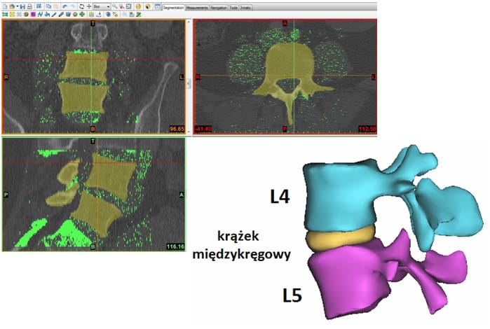 Generowanie modelu 3D segmentu ruchowego L4-L5 kręgosłupa