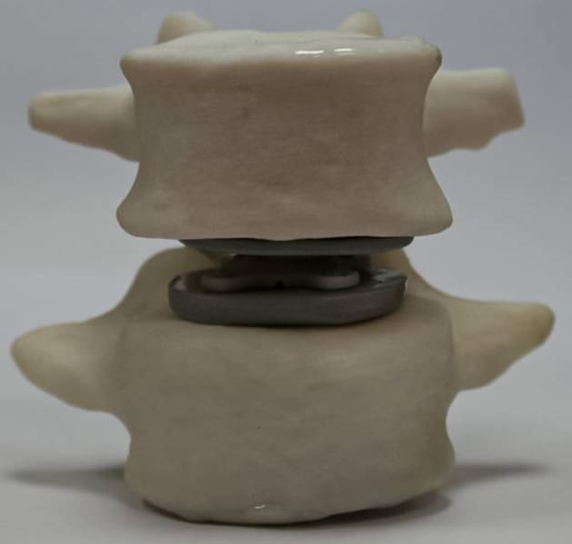 Model segmentu L4-L5 kręgosłupa z modelem endoprotezy